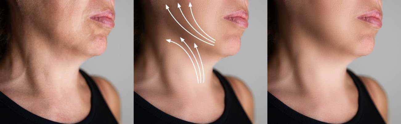 Before and after results of double chin removal treatment, showing improved jawline definition.
