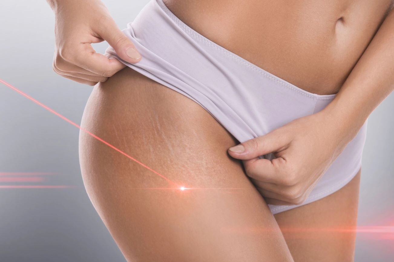 Close-up of a woman's thigh undergoing laser stretch mark treatment for skin improvement.