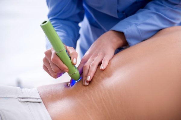 Acne Laser Treatment Toronto 2 Scar Removal Laser Treatment for Stretch Marks