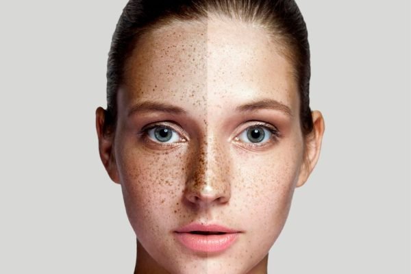 Close-up of a woman's face showing before and after results of Scar & Pigment Correction treatment.
