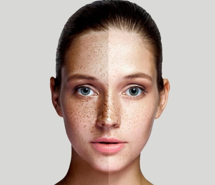 Pico Laser Treatment | Laser Face Rejuvenation 6 Close-up of a woman's face showing before and after results of Scar & Pigment Correction treatment.